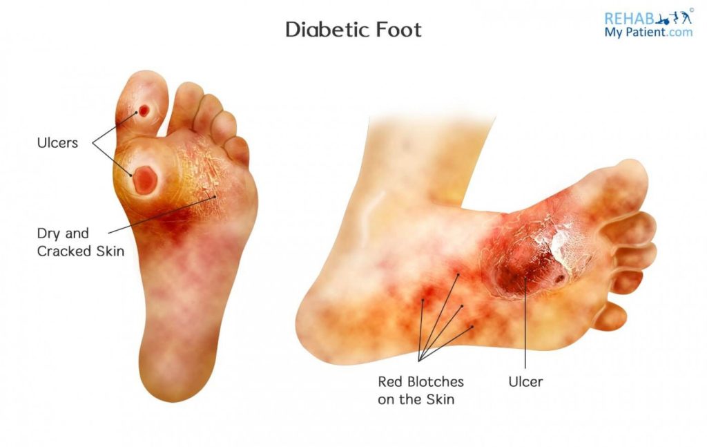 What Is Charcot Foot In Diabetes? – Health Bob